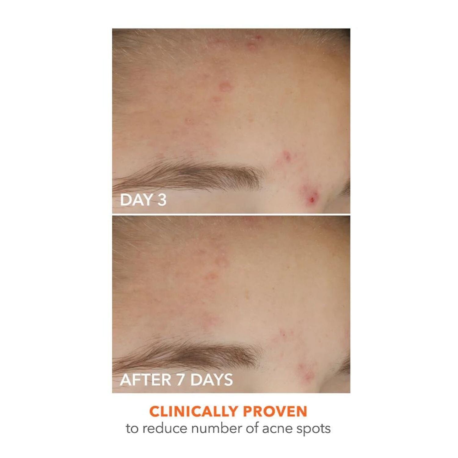 Dr. Dennis Gross Skincare Alpha Beta On The Spot Gel (30ml) Acne Dr. Dennis Gross