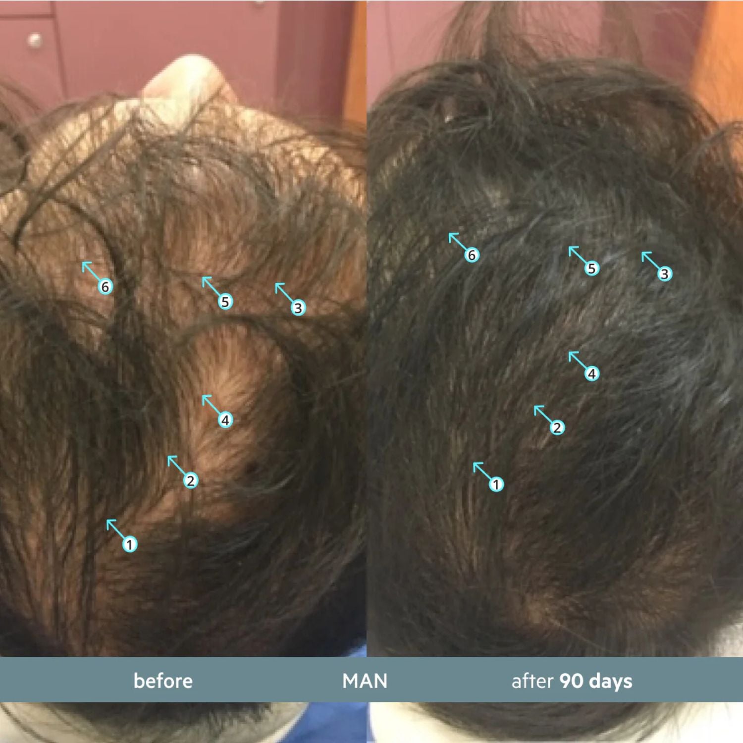 Before and after comparison of hair growth on a man's head, showing visible differences over 90 days.