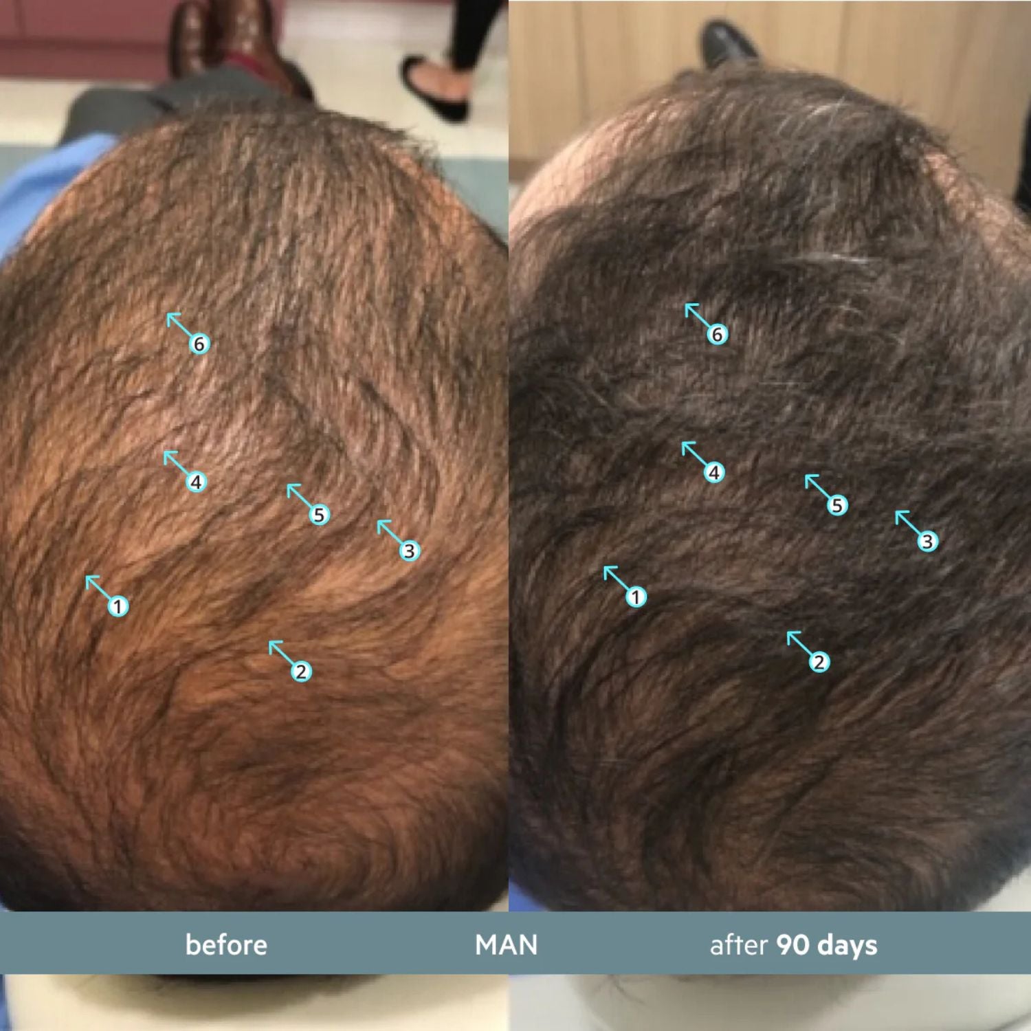 Before and after comparison of a man's hairline with marked areas on a scalp.