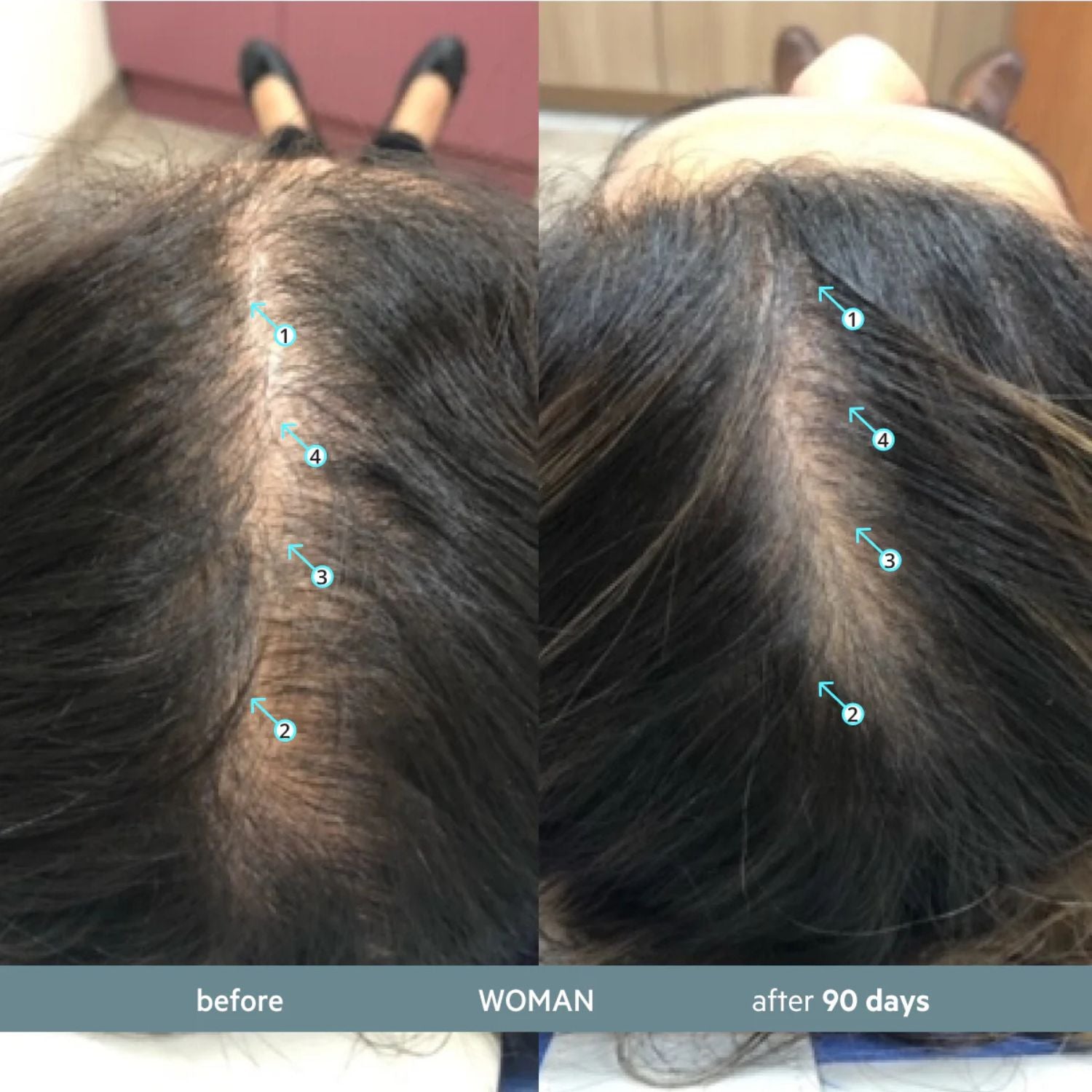 Before and after comparison of a woman's hair growth treatment on her scalp.