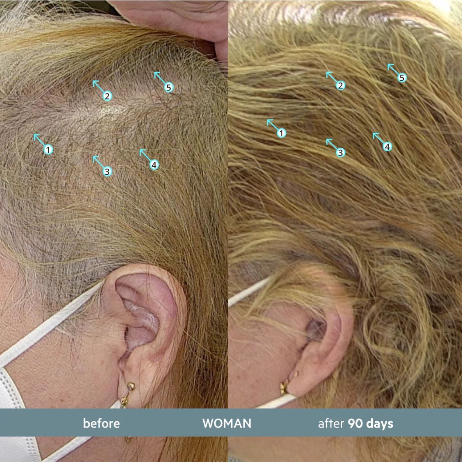 Before and after comparison of a woman's hair growth treatment on her scalp.